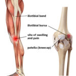IT-band-syndrome-iliotibial-band-syndrome-ITBS-labeled-400
