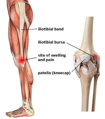 IT-band-syndrome-iliotibial-band-syndrome-ITBS-labeled-400
